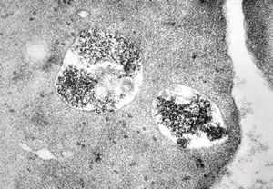 M,24y. | bone marrow - haemolytic anemia